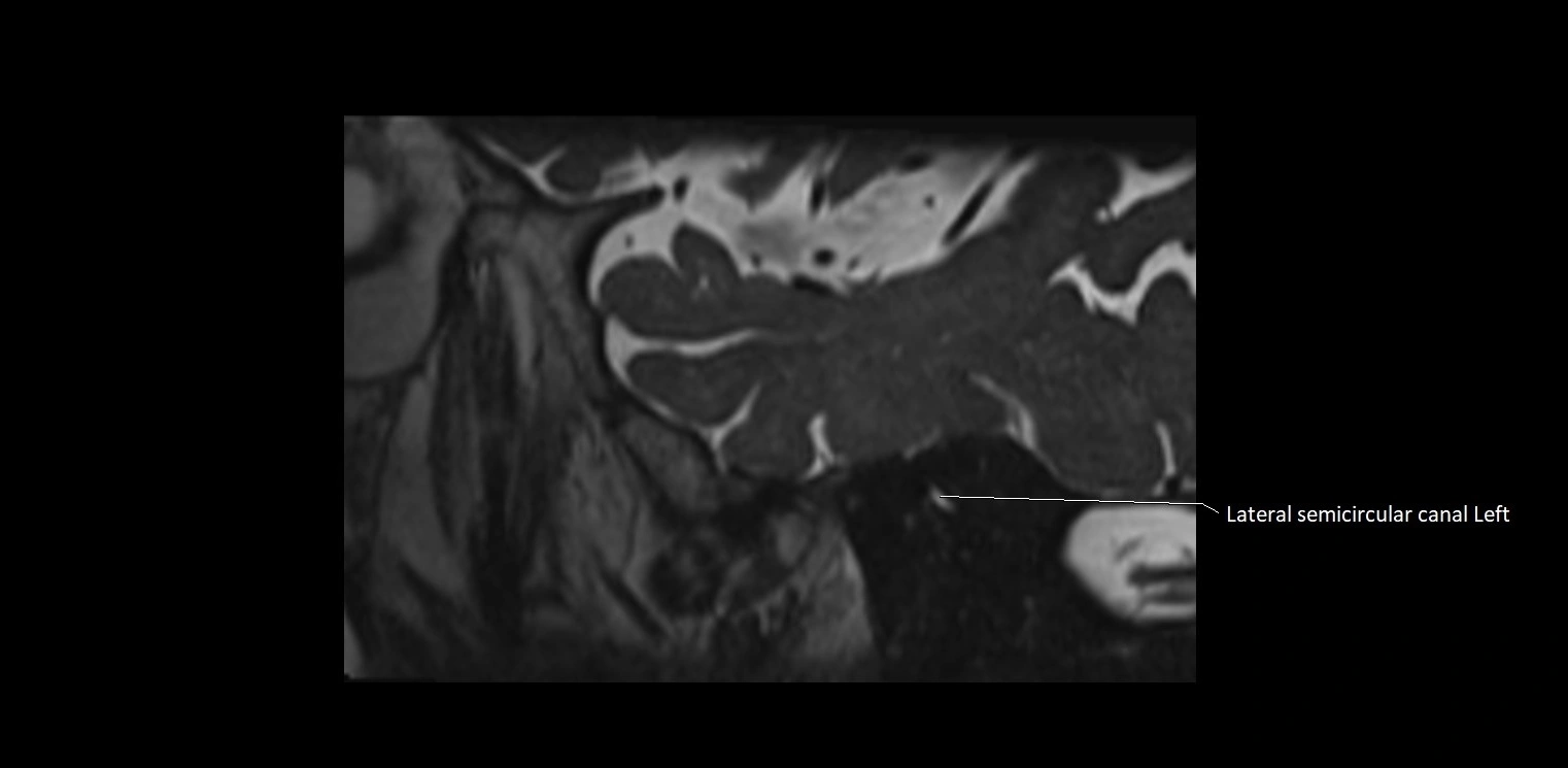 Cranial nerve sagittal anatomy MRI 3T image 1.webp